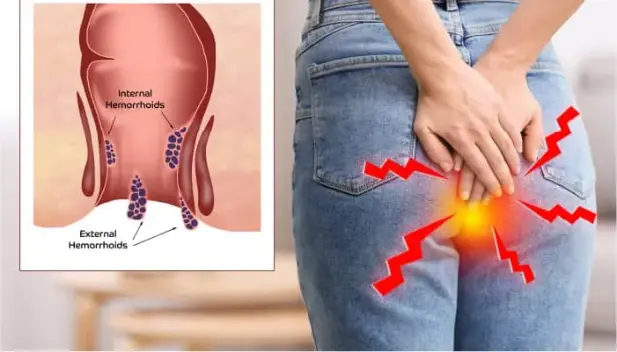 Piles-Causes and Surgery