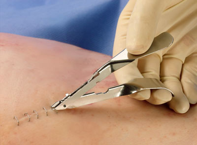 Skin Stapler Remover